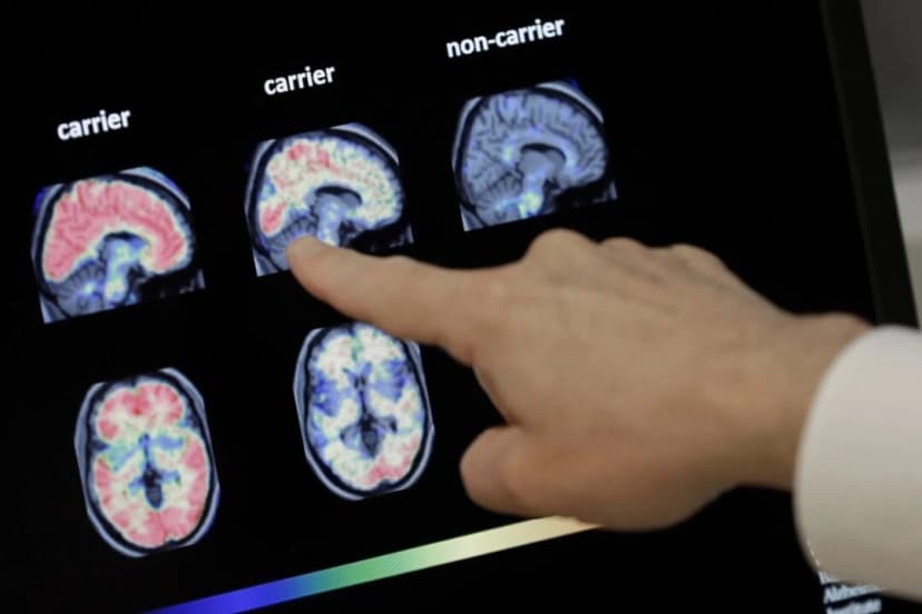 Un médico observa escáneres cerebrales PET (tomografia por emisión de positrones) en el Banner Alzheimers Institute de Phoenix, Arizona, el 14 de agosto de 2018. Matt York / Archivo AP