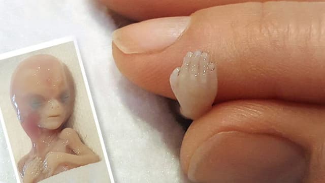 "No es un residuo médico": Tomó fotos de su bebé abortado y sacó a la luz una cruel verdad
