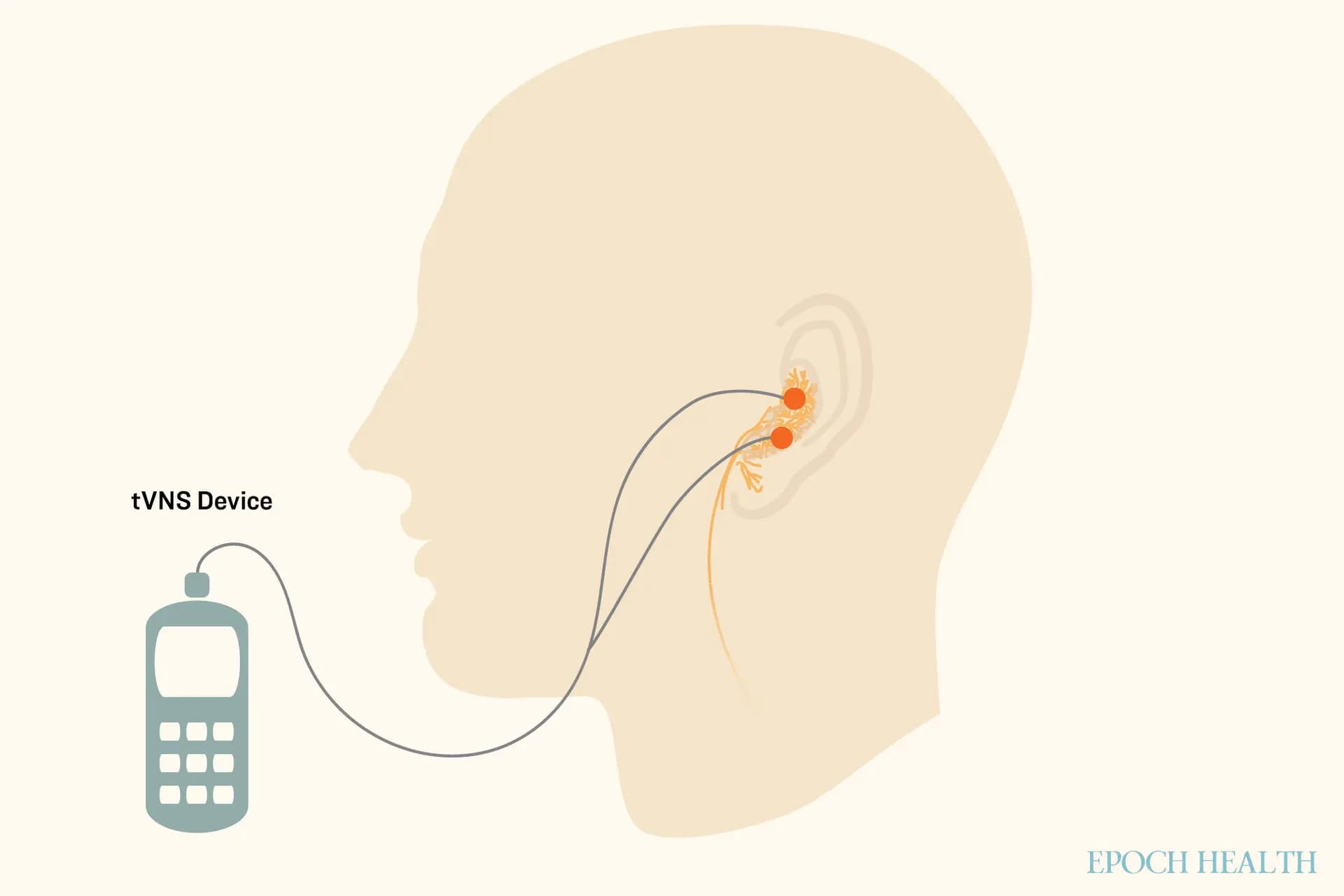 La estimulación transcutánea del nervio vago auricular (taVNS) es un tipo de tVNS que estimula el nervio vago a través del oído. (Ilustración de The Epoch Times / Shutterstock)