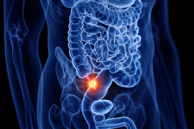 Cáncer de apéndice se cuadruplica en millennials mayores, los síntomas suelen ser ignorados