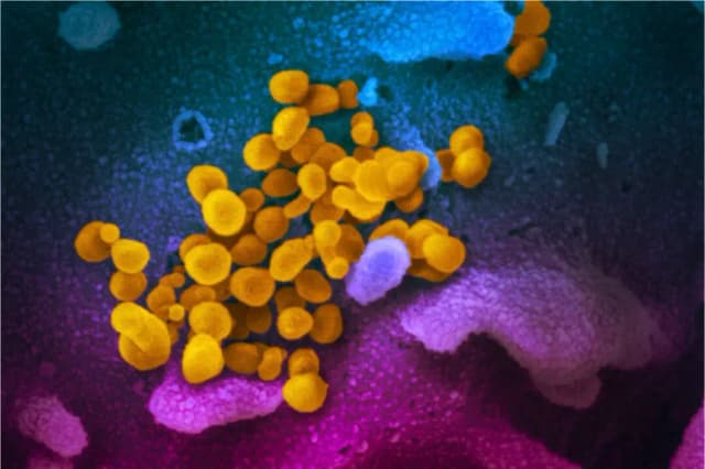 Esta imagen de microscopio electrónico de barrido, publicada el 13 de febrero de 2020, muestra el SARS-CoV-2 (amarillo), también conocido como virus CCP, el virus que causa la COVID-19, aislado de un paciente en EE. UU., emergiendo de la superficie de células (azul/rosa) cultivadas en el laboratorio. Cortesía de NIAID-RML