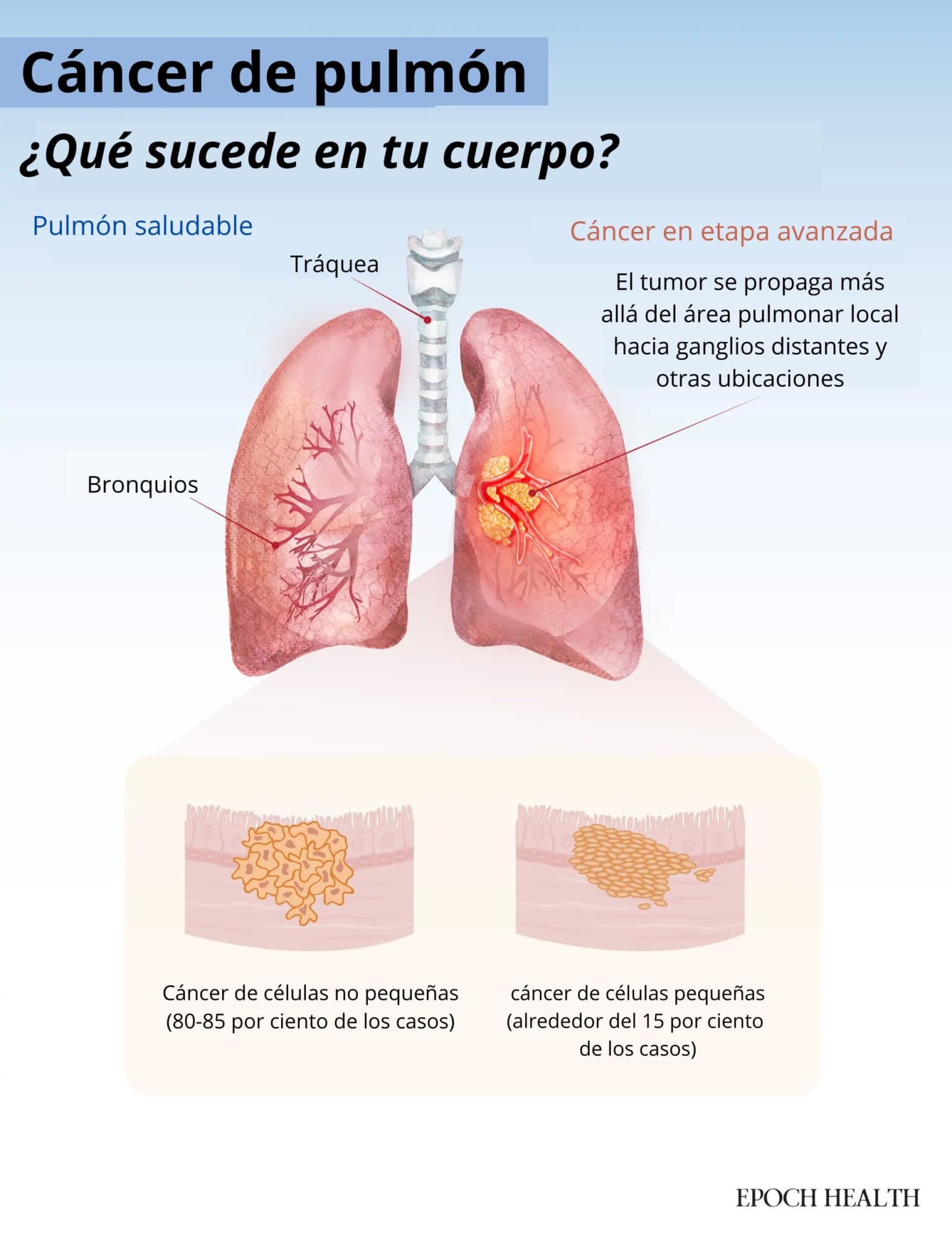 El cáncer de pulmón se produce cuando crecen células anormales en los pulmones. Los dos tipos principales —cáncer de pulmón de células no pequeñas y cáncer de pulmón de células pequeñas— difieren en su crecimiento, propagación y respuesta al tratamiento. (Ilustración de The Epoch Times / Shutterstock).