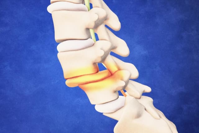 Cómo tratar la espondilolistesis sin cirugía