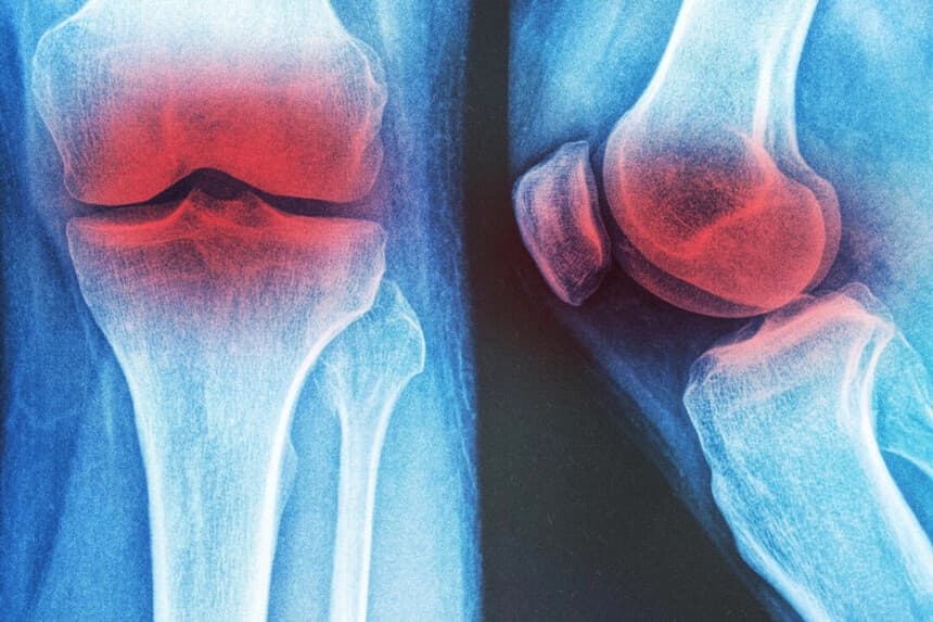 3 terapias no farmacológicas para la osteoartritis de rodilla