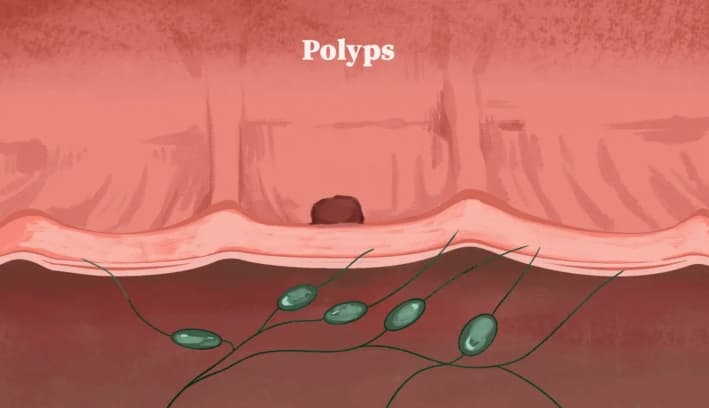 Cómo se desarrolla el cáncer colorrectal a partir de pólipos. (Ilustración de The Epoch Times)
