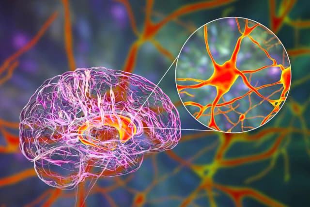 Cómo el procesamiento de azúcar en el cerebro podría influir en el riesgo de padecer Alzheimer
