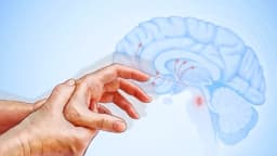 Enfermedad de Parkinson: El segundo trastorno neurodegenerativo más común y sus primeros síntomas