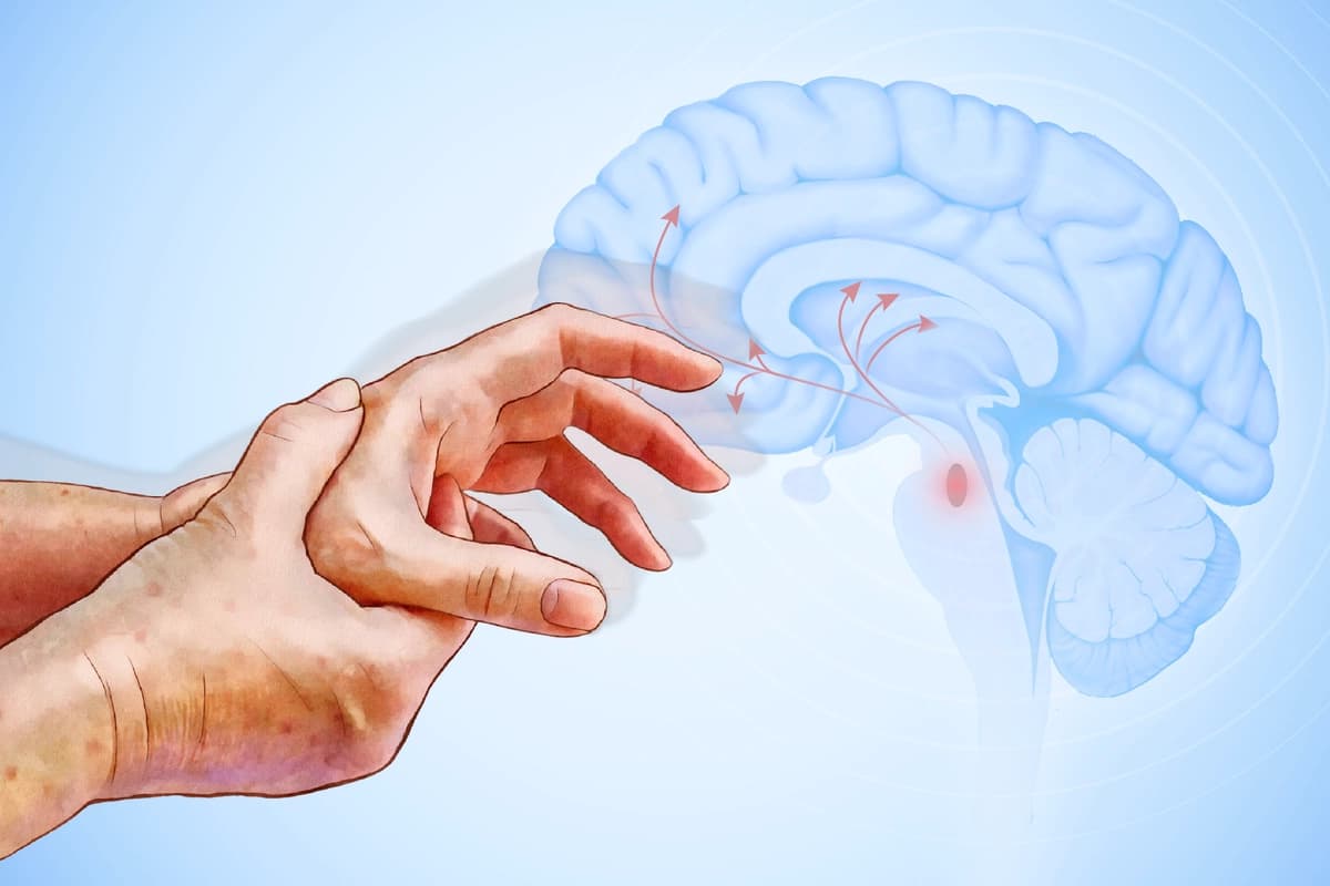 Los temblores de la enfermedad de Parkinson suelen comenzar en las manos y pueden empeorar a medida que la enfermedad progresa. (Ilustración de The Epoch Times, Shutterstock).
