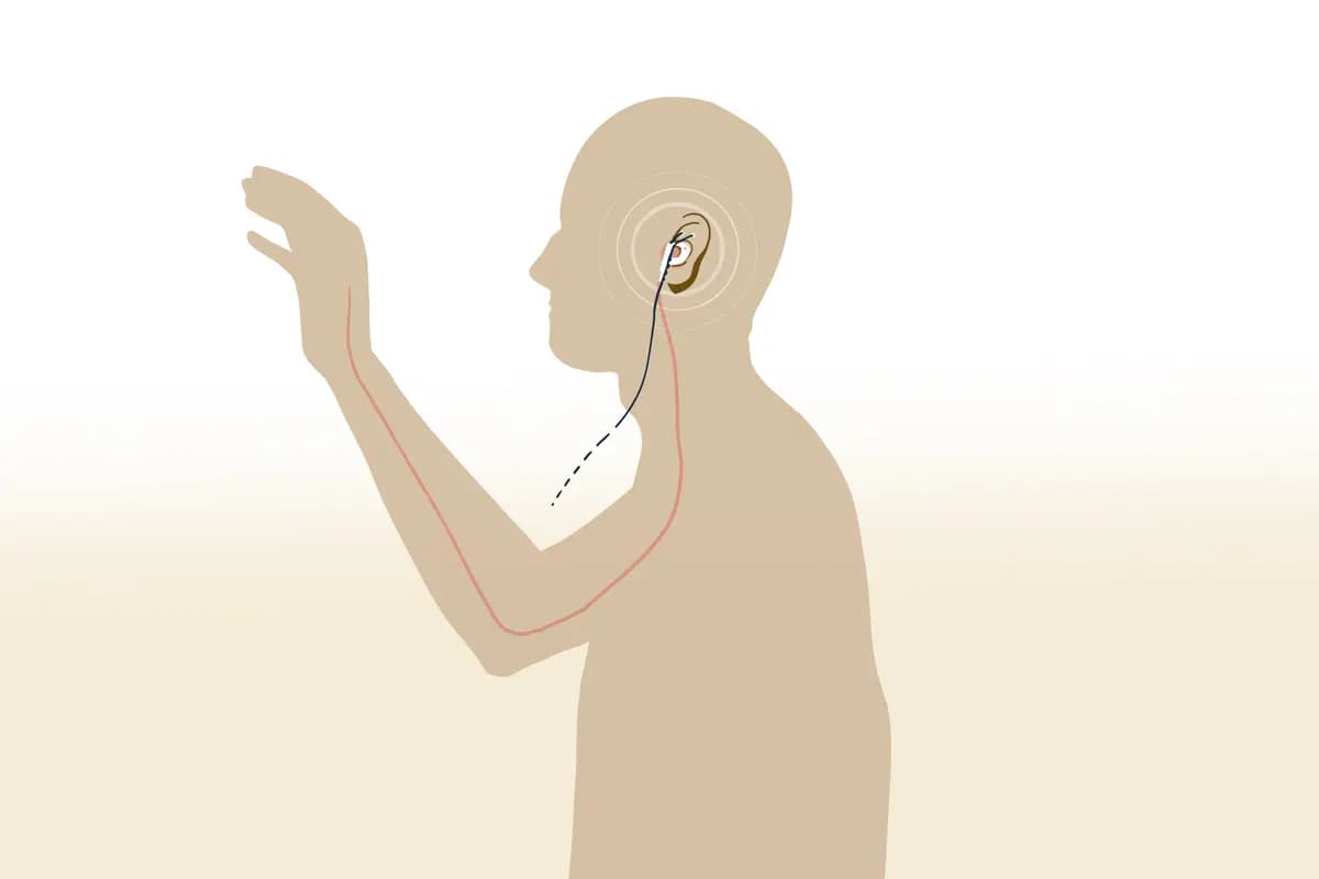 El dispositivo tVNS y cómo puede ayudar a restaurar la función del brazo después de un accidente cerebrovascular. (Ilustración de The Epoch Times).
