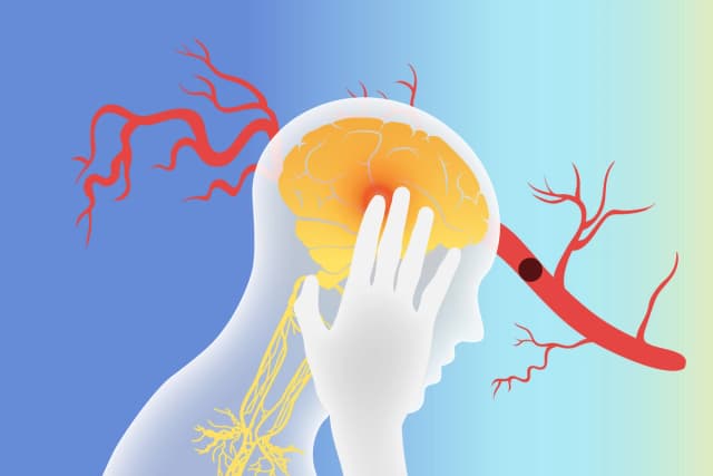Estimular el nervio vago podría ayudar en la recuperación de un accidente cerebrovascular