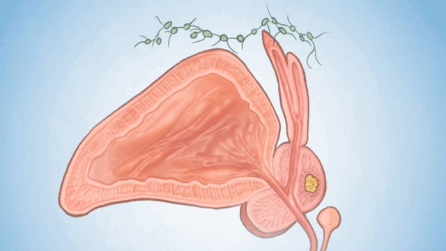 El cáncer de próstata es una enfermedad en la que crecen células anormales en la glándula prostática, que en ocasiones se extienden a otras partes del cuerpo. (Ilustración de The Epoch Times, Shutterstock)