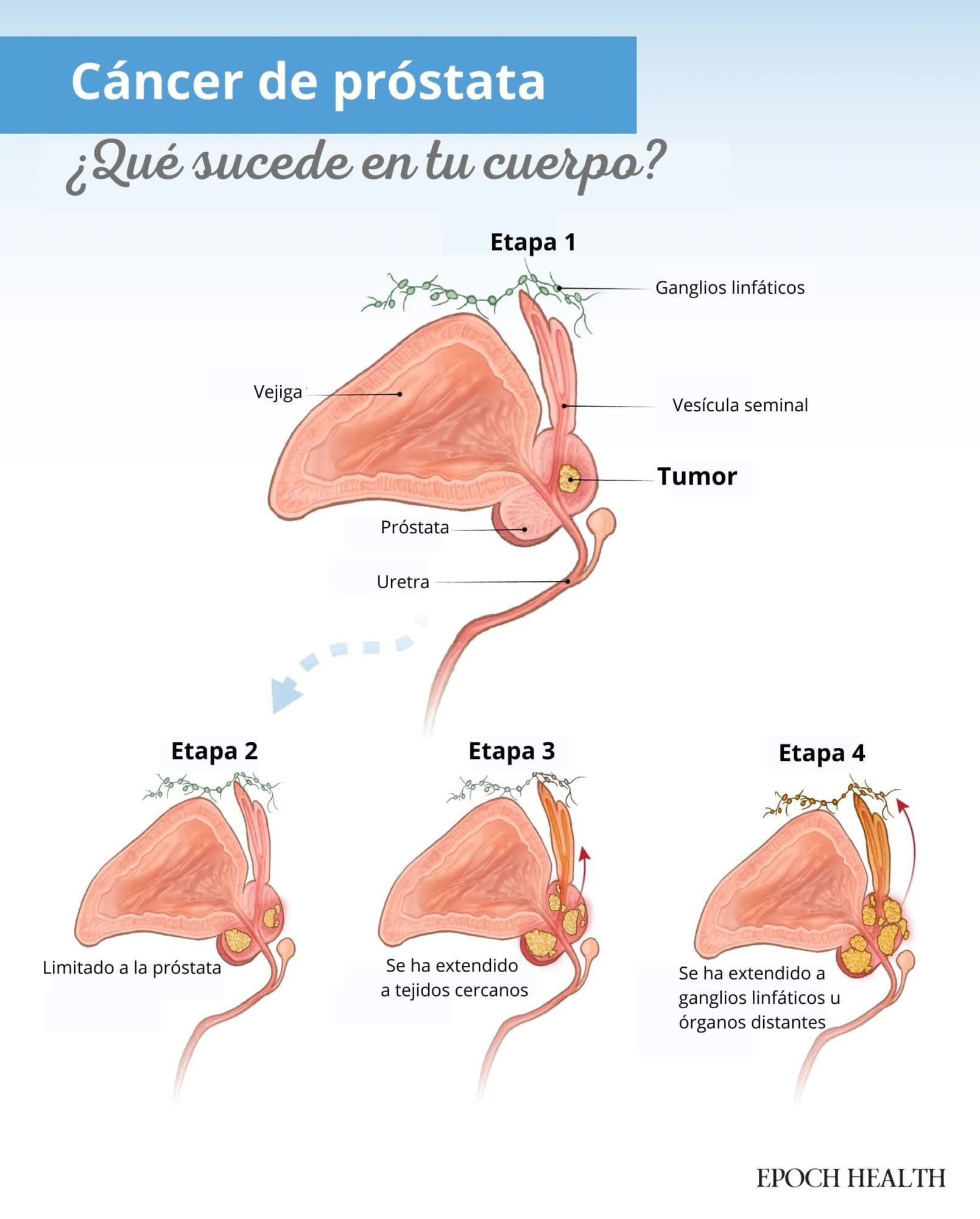 El cáncer de próstata puede progresar desde estar confinado a la próstata hasta propagarse a tejidos cercanos, ganglios linfáticos u órganos distantes. (Ilustración de The Epoch Times, Shutterstock).