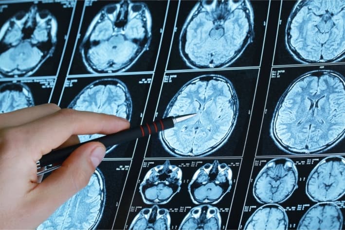 Resonancia magnética cerebral. (Billion Photos/Shutterstock)
