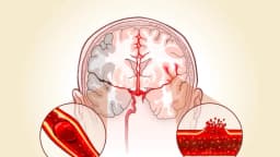 Accidente cerebrovascular, una afección que ocurre cada 40 segundos con efectos duraderos: señales