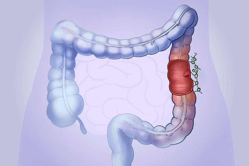 Cáncer de colon: Cómo los pólipos inofensivos pueden volverse peligrosos, primeros signos