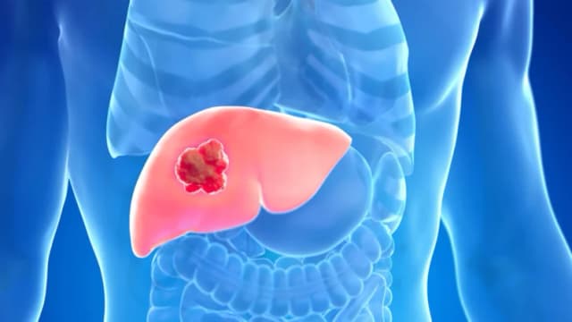 El 60 por ciento del cáncer de hígado se puede prevenir: Te explicamos cómo