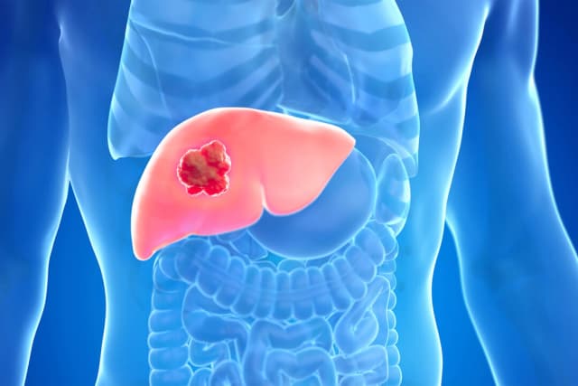 El 60 por ciento del cáncer de hígado se puede prevenir: Te explicamos cómo