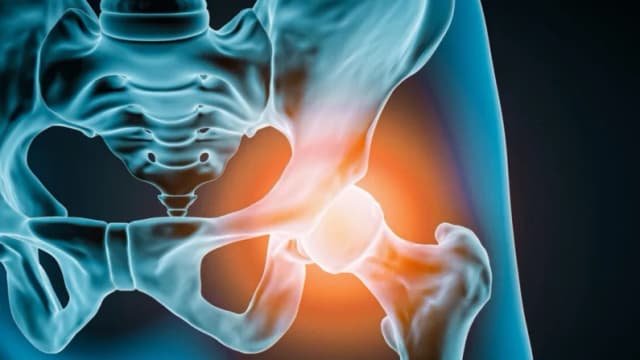 Cómo saber si es el momento de un reemplazo de cadera
