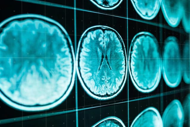 ¿Por qué se tarda tanto en diagnosticar la demencia?