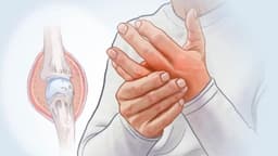 Artritis reumatoide: cuando el sistema inmunitario ataca las articulaciones: síntomas clave