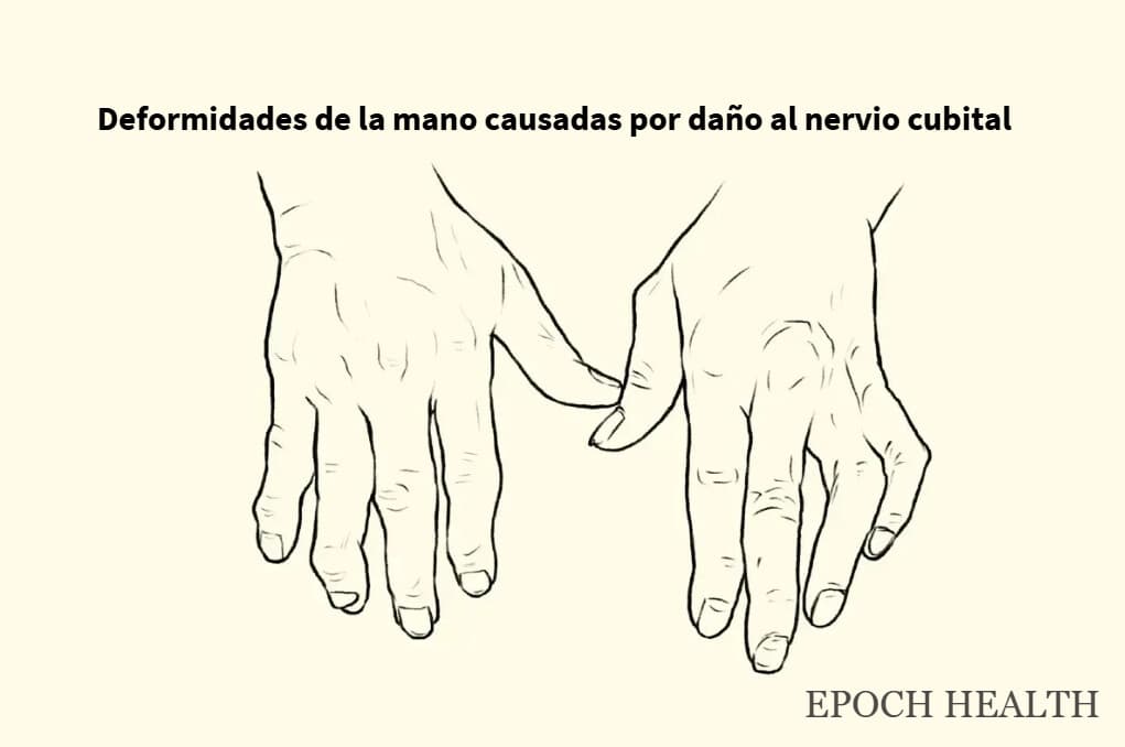 Neuropatía periférica diabética. (The Epoch Times).