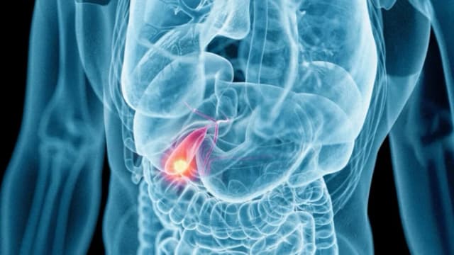 La extirpación de la vesícula biliar ¿es siempre necesaria? Lo que los pacientes deben saber