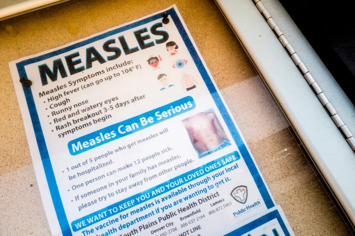Un cartel sobre el sarampión en Seminole, Texas, el 9 de abril de 2025. (Brandon Bell/Getty Images)