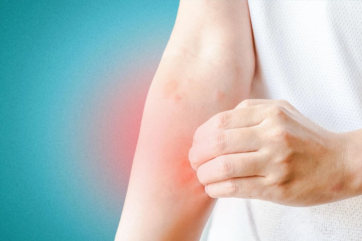 Irritación de la piel estacionaria. (Kwangmoozaa/Shutterstock).