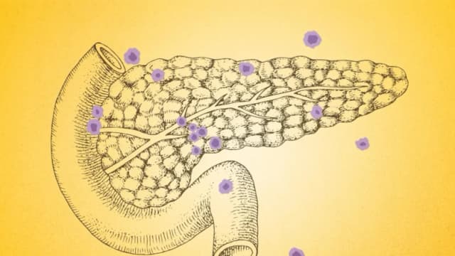 7 señales silenciosas del cáncer de páncreas que casi nadie nota