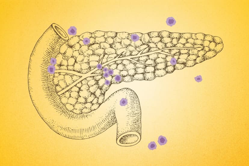 Siete señales clave del cáncer de páncreas que la mayoria pasa por alto. (Ilustración de The Epoch Times, Shutterstock).