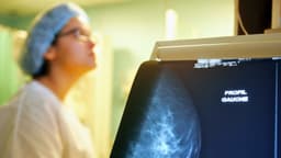 Grupo de médicos actualiza directrices sobre la detección del cáncer de mama