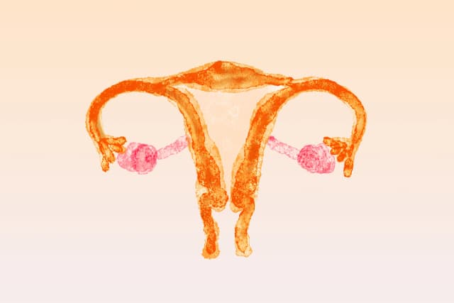 Por qué el síndrome de ovario poliquístico es una de las condiciones más incomprendidas que enfrentan las mujeres. (Ilustración de The Epoch Times, Getty Images).