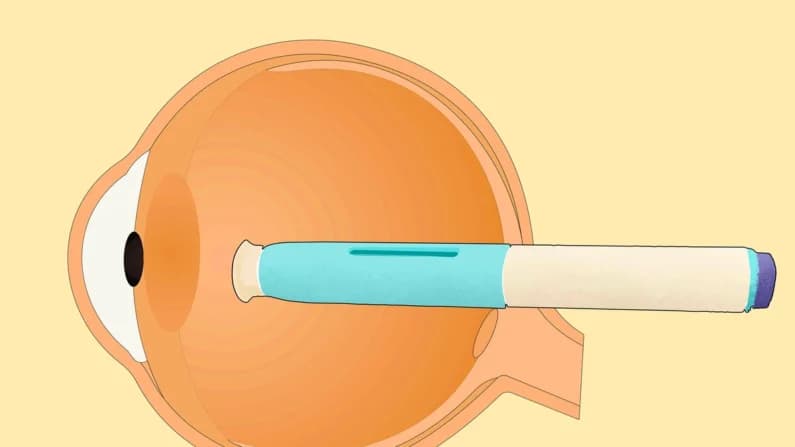 Revelan que medicamentos para la migraña podrían reducir el riesgo de glaucoma: Estudio