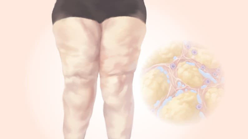 Lipedema: La acumulación dolorosa de grasa que se confunde con obesidad