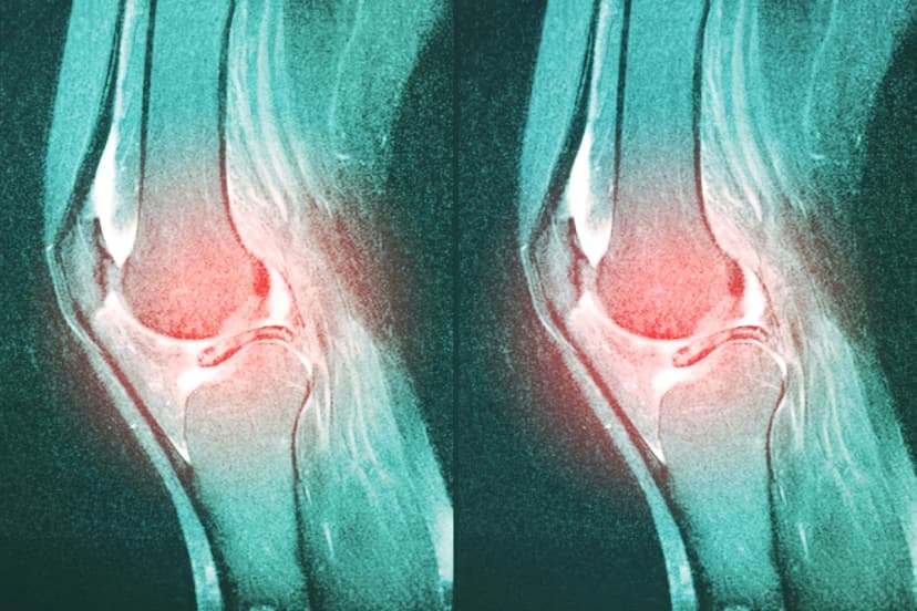 Una de las cirugías de rodilla más comunes podría estar causando más daño que beneficio. (Semnic/Shutterstock).