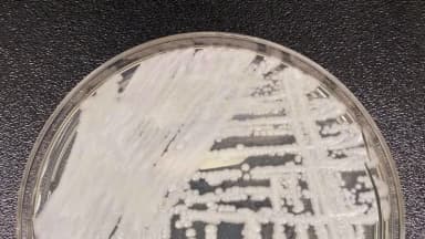 CDC reportan casos de hongo potencialmente mortal en 27 estados en lo que va del año