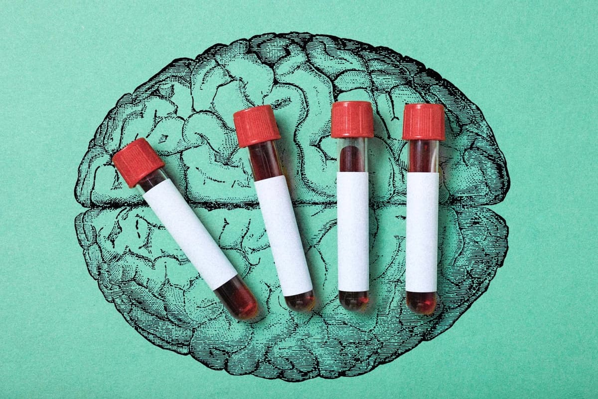 Un análisis de sangre puede detectar el Alzheimer. (Ilustración de The Epoch Times, Shutterstock).