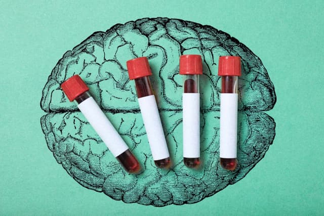 Un análisis de sangre puede detectar el Alzheimer. (Ilustración de The Epoch Times, Shutterstock).