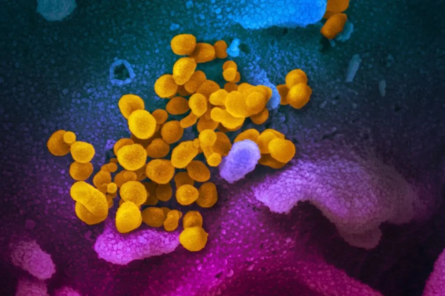 El virus COVID-19 se observa en color amarillo, emergiendo de las células. (NIAID)
