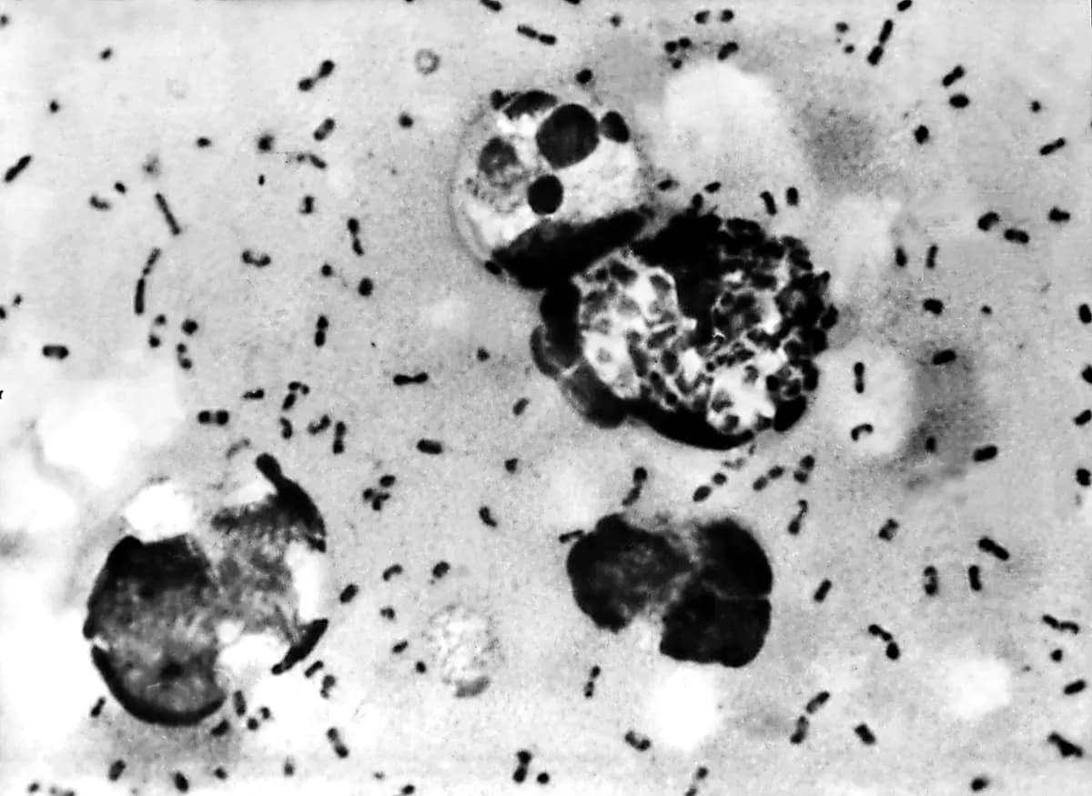 <em>En esta fotografía sin fecha, se observa una muestra de linfa extraída de un ganglio linfático adenopático (bubón) de un paciente con peste bubónica, obtenida de un frotis de peste bubónica, que muestra la presencia de la bacteria Yersinia pestis, causante de la enfermedad. (Centros para el Control y la Prevención de Enfermedades/Getty Images).</em>