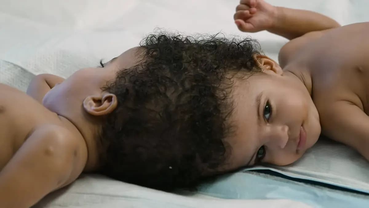 <em>Las hermanas gemelas Hiyab y Wuhbto nacieron unidas por la coronilla. (Hospital Infantil SSM Health Cardinal Glennon).</em>