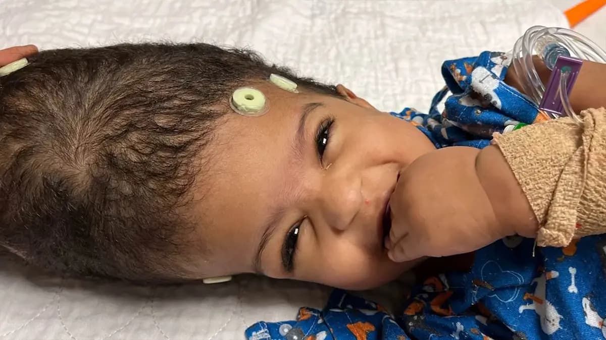 <em>Una fotografía en primer plano captura la sonrisa de una de las gemelas antes de su histórica cirugía de separación de 25 horas. (Hospital Infantil SSM Health Cardinal Glennon).</em>