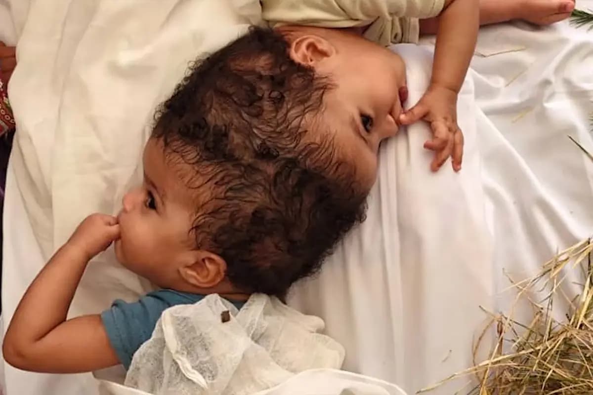 <em>Las gemelas siamesas yacen juntas al comienzo de su tratamiento médico. (Hospital Infantil SSM Health Cardinal Glennon).</em>