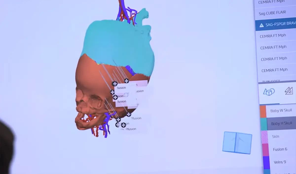 <em>Una representación digitalizada en 3D muestra la intrincada anatomía craneal y vascular de los gemelos siameses. (Hospital Infantil SSM Health Cardinal Glennon).</em>