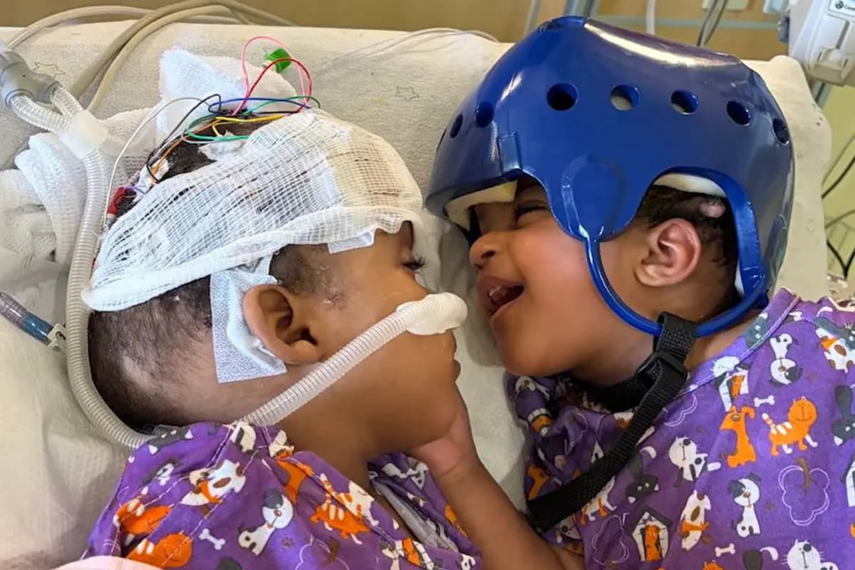 <em>Las hermanas gemelas Hiyab y Wuhbto interactúan en una sala de recuperación del hospital tras su exitosa separación. (Hospital Infantil SSM Health Cardinal Glennon).</em>