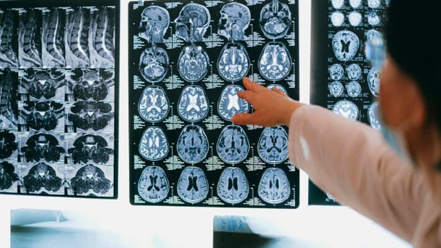 Fármaco antiinflamatorio suprime el sistema inmunológico y afecta el tratamiento de cáncer cerebral