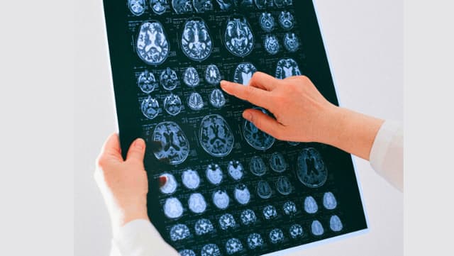 "Sustancias químicas eternas" son encontradas por primera vez en el tejido cerebral humano: Estudio