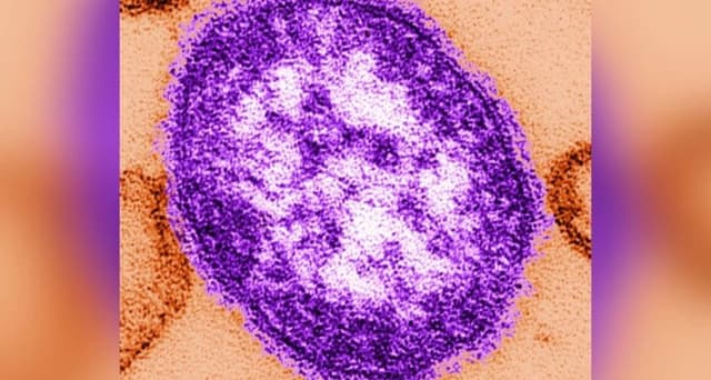 OMS dice que la región europea registró el mayor número de casos de sarampión en décadas