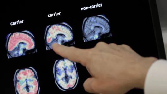 Enfermedad de Alzheimer: La enfermedad neurodegenerativa más común. Estas son las causas
