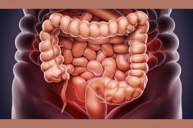Iniciativa de detección precoz reduce 50 % el cáncer colorrectal y las muertes por la enfermedad